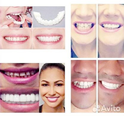 Виниры Snap-On Smile Виниры Snap-On Smile