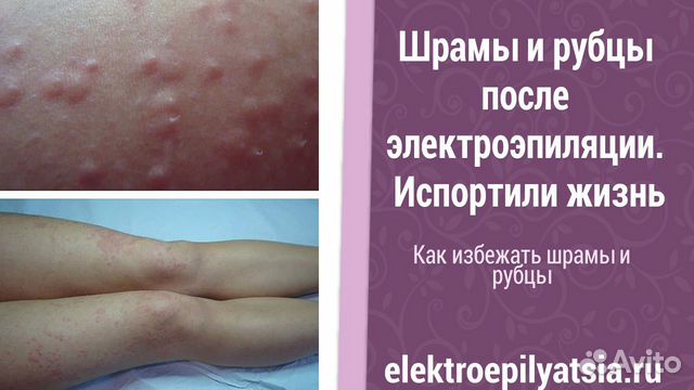 Обучение электроэпиляции (курсы) Москва Обучение электроэпиляции (курсы) Москва