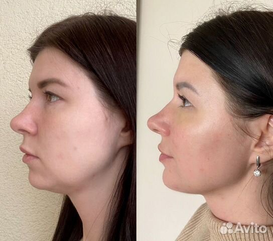 Массаж лица