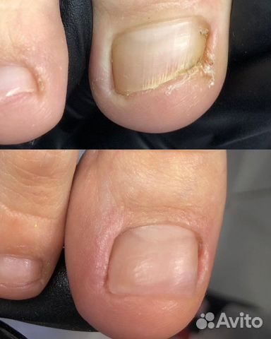 Протезирование ногтей